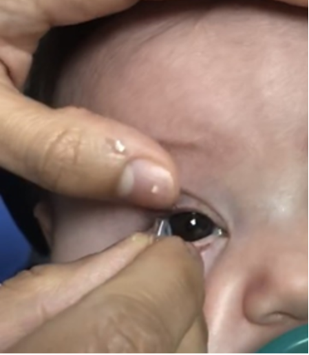 Fingers placing a contact lens on a baby's eye