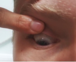 Finger pressing on the top eyelid of an eye looking down
