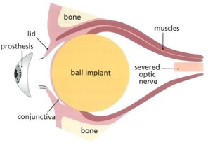 Diagram of an implant in the eye socket