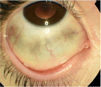 Image of an eye with grey or brown patches
