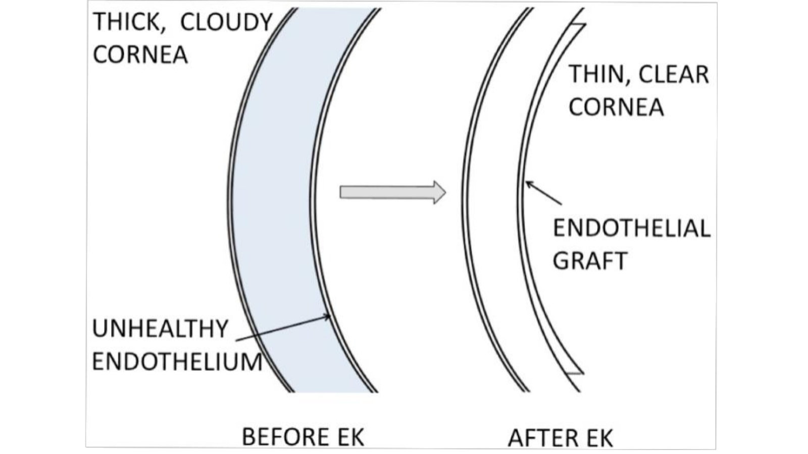 Before and after diagram of endothelial keratoplasty