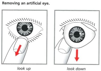 Diagram showing how to remove an artificial eye