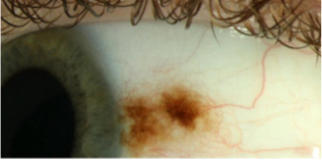 Photo of Naevus with a lot of melanin pigment