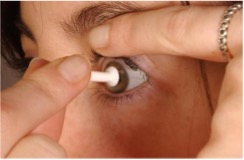 Fingers holding an eye open whilst a device is being used to remove a contact lens