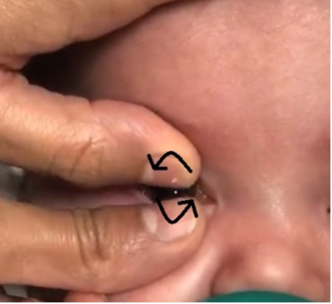 Fingers removing a contact lens from a baby's eye