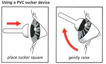 Diagram showing how to remove a prosthetic eye using a silicone extractor